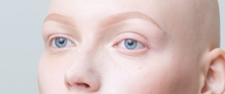 Alopecia