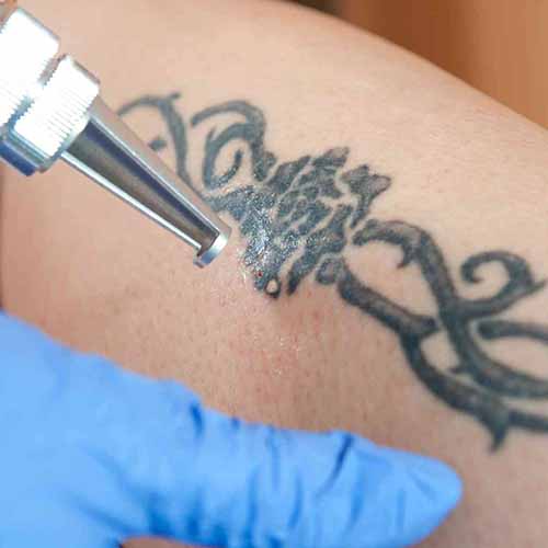 Îndepărtare tatuaj cosmetic LASER
