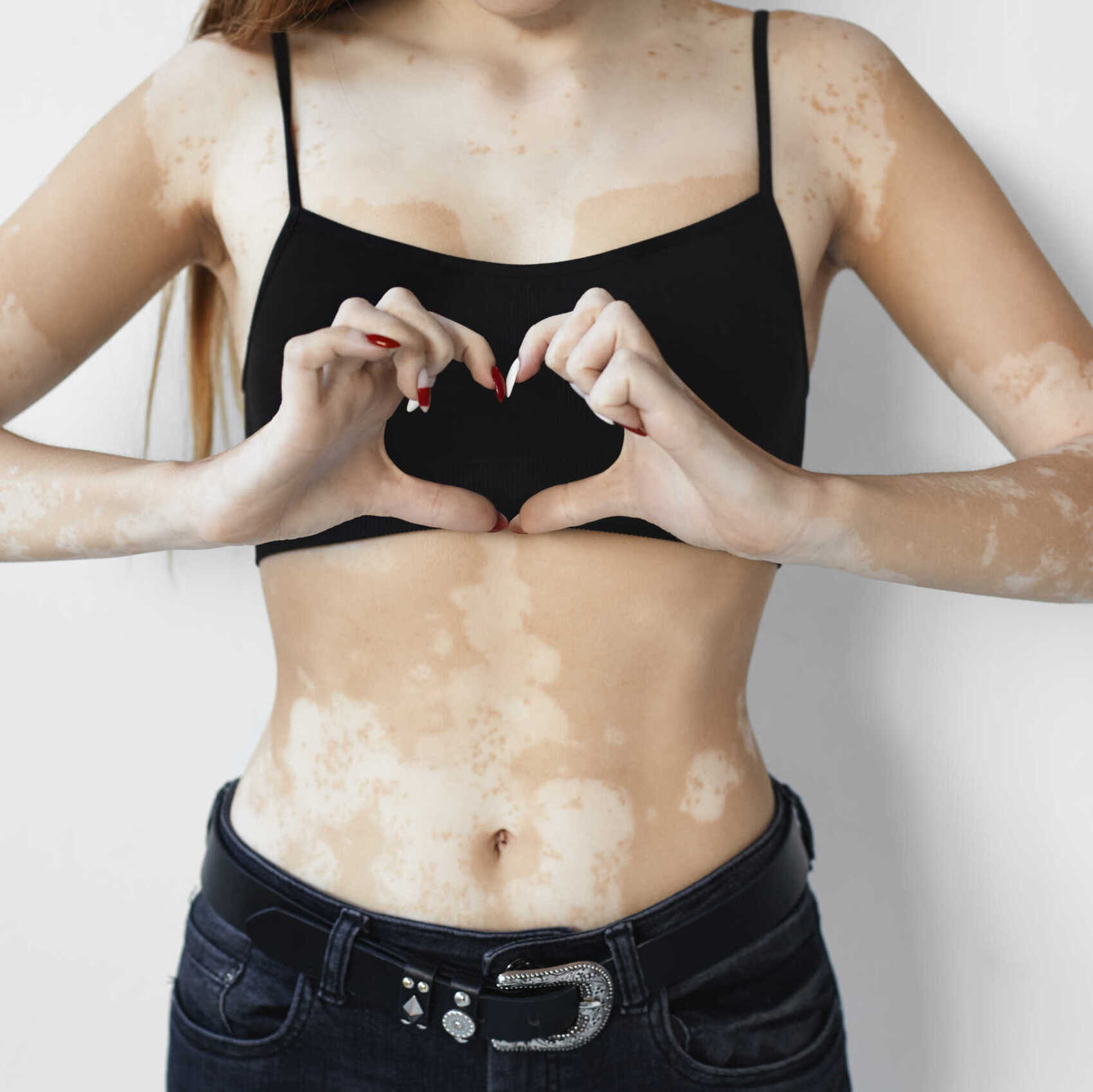 shutterstock_1220647288 Vitiligo