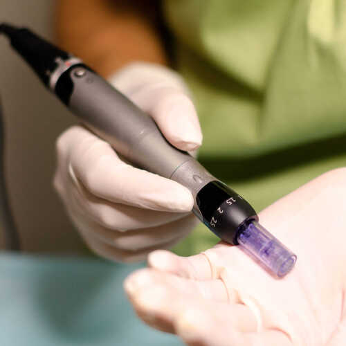 Microneedling / Mezoterapie cu Ser Bruno Vassari