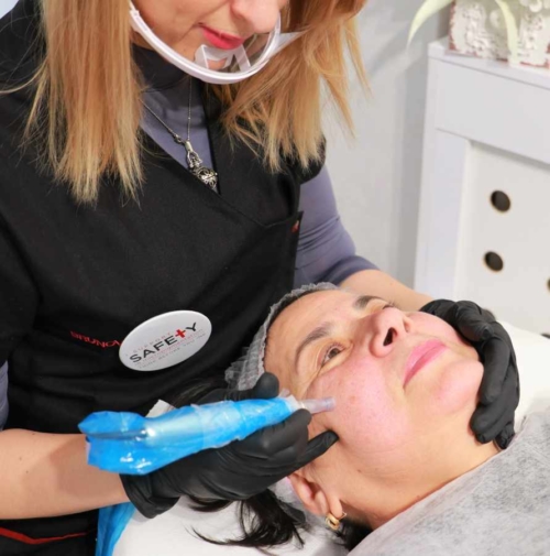 Microneedling – terapia cu microace