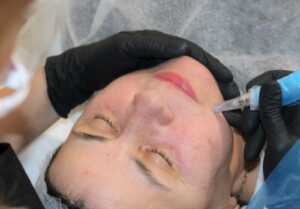 Microneedling – terapia cu microace