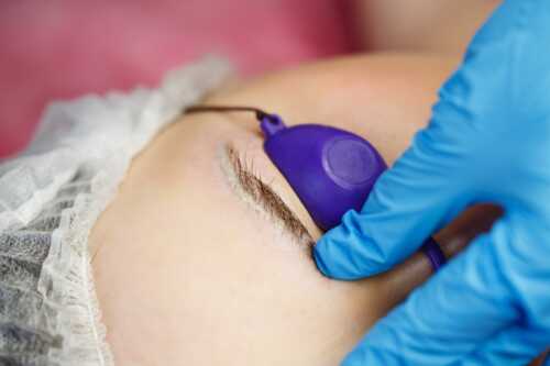 Îndepărtare tatuaj cosmetic SOLUŢIE CHIMICĂ
