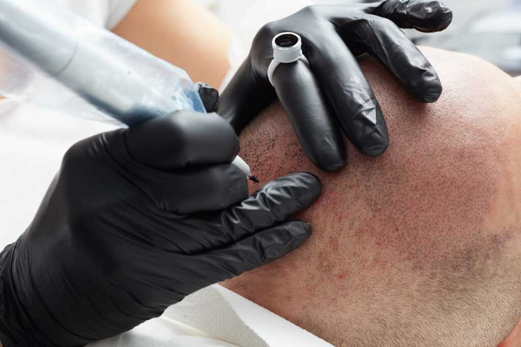 Dermopigmentarea medicală