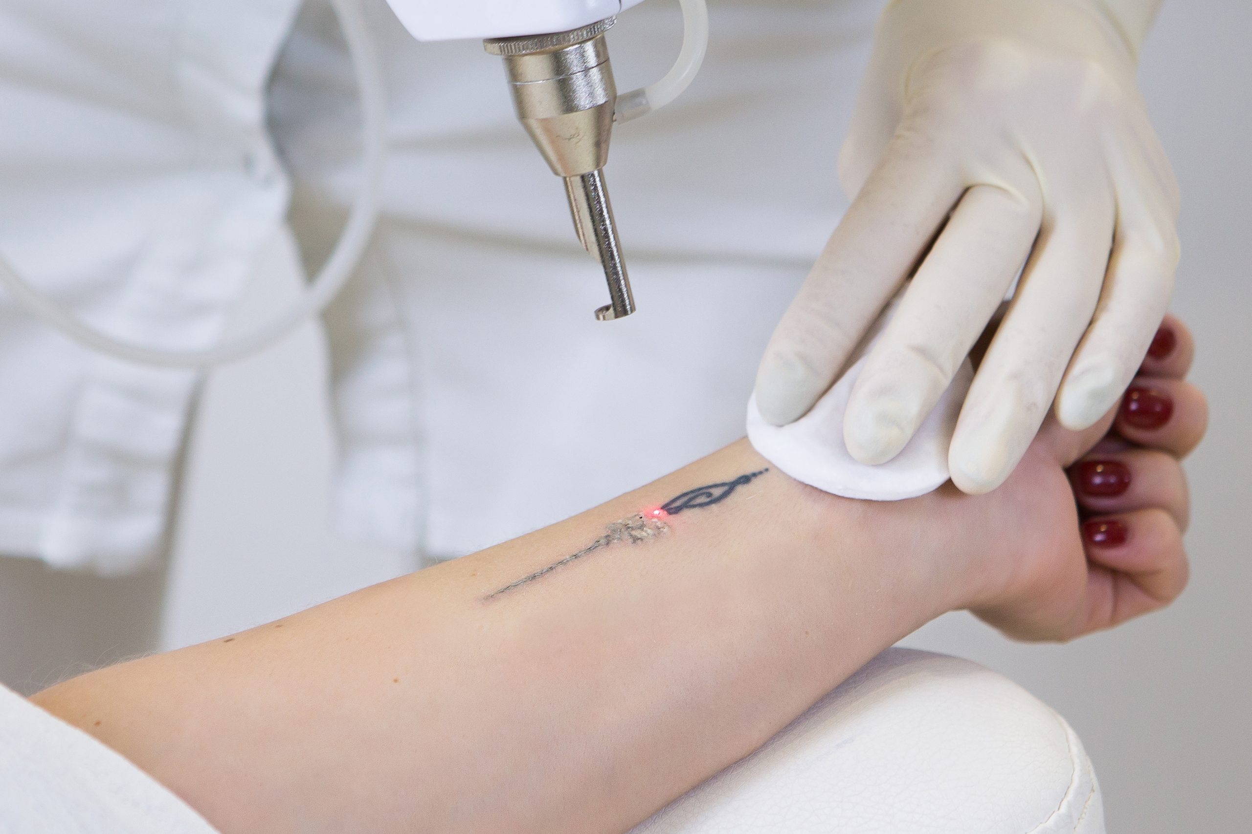 Îndepărtarea tatuajelor