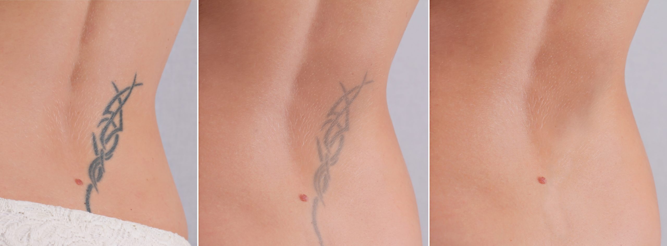 Îndepărtarea tatuajelor