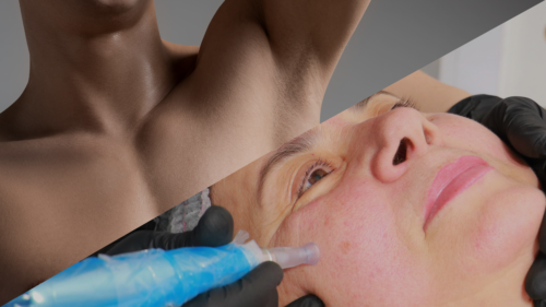MICRONEEDLE + 3 ȘEDINȚE EPILARE DEFINITIVĂ AXILĂ