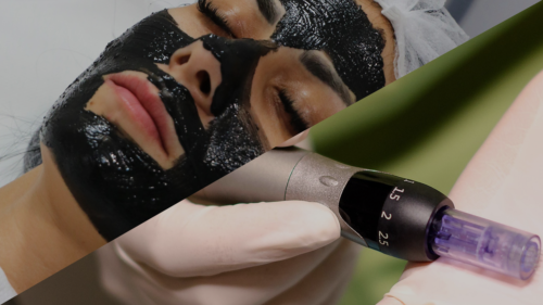 PEELING LASER CARBON + 2 ȘEDINȚE MICRONEEDLE SER REJUVENARE